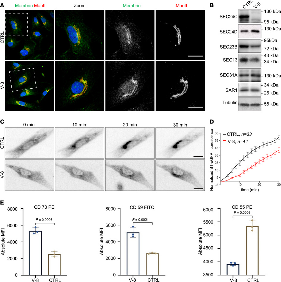 The c.333del p.(Ser112Profs*115) variant affects protein levels of COPII...