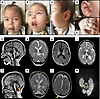 Clinical findings and MRI results of individual V-8.