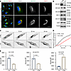 The c.333del p.(Ser112Profs*115) variant affects protein levels of COPII co