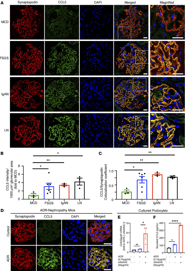 CCL5 expression in podocytes of human glomerular diseases and ADR-induce...