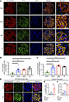 CCL5 expression in podocytes of human glomerular diseases and ADR-induced n