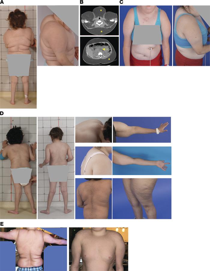 Subcutaneous fat accumulation with lipodystrophy of lower extremities in...