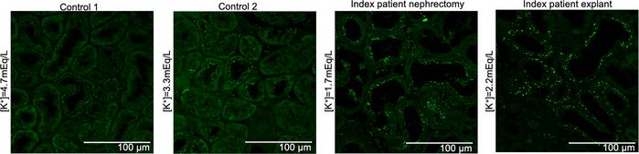 Gly167Cys mutation associates with increased condensates.
Representative...