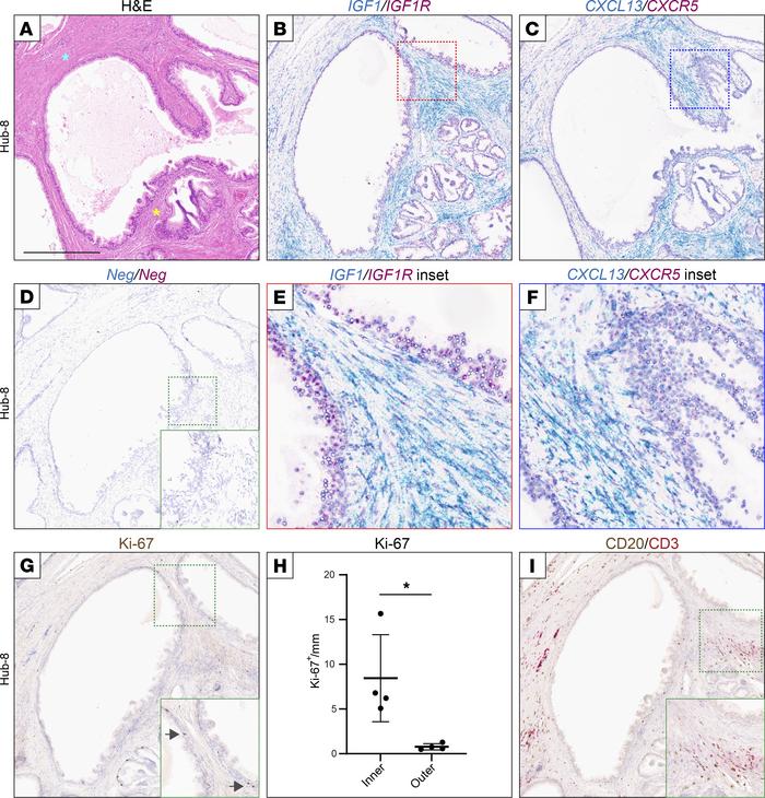 IGF1 and CXCL13 receptors are expressed in adjacent prostate ductal epit...