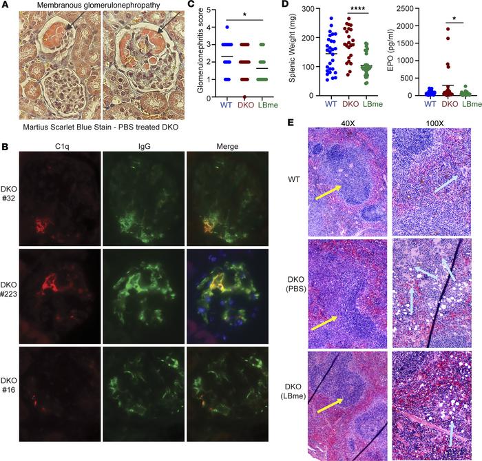 Membranous glomerulonephropathy and immune complex deposition in glomeru...