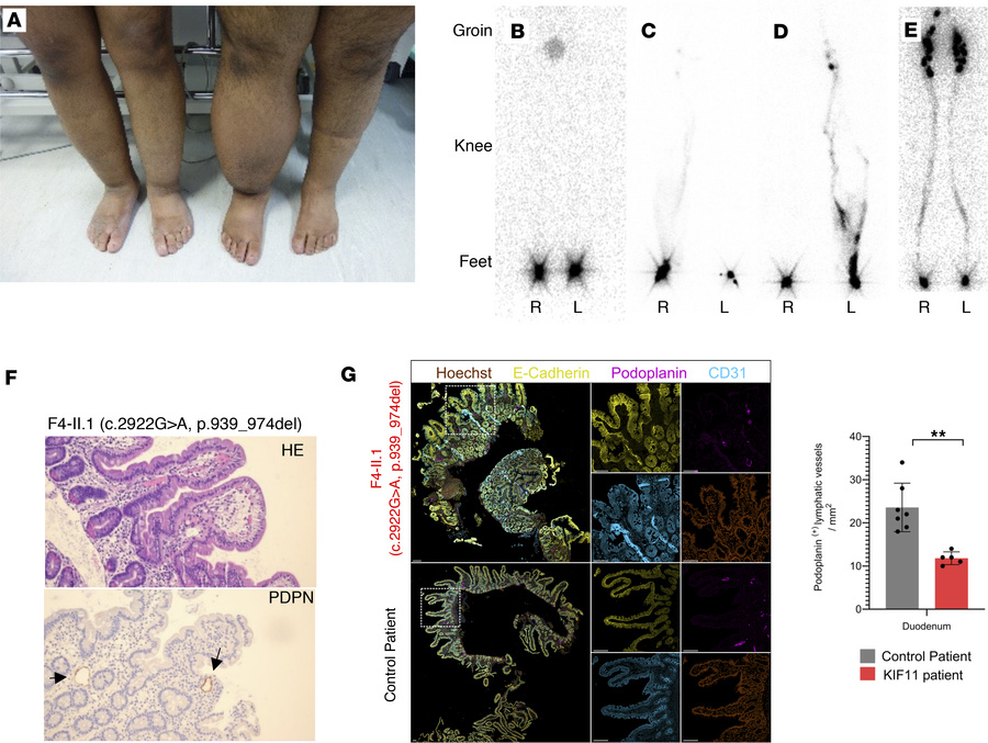 Patients with MLC show lymphatic abnormalities.
(A) Photography of lower...