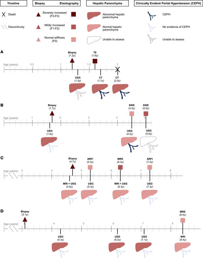 Evaluation of extent of liver fibrosis by elastography, biopsy, and conv...