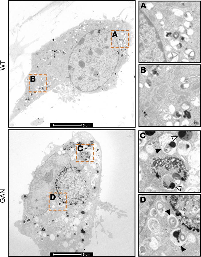 GAN is associated with abnormal autophagic organelles.
Transmission elec...