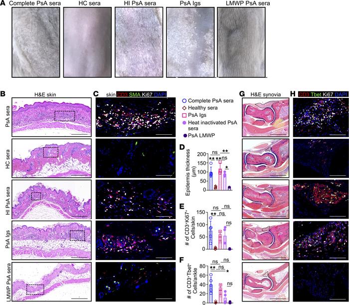 Immunoglobulins, but not complement, are essential to induce psoriasifor...