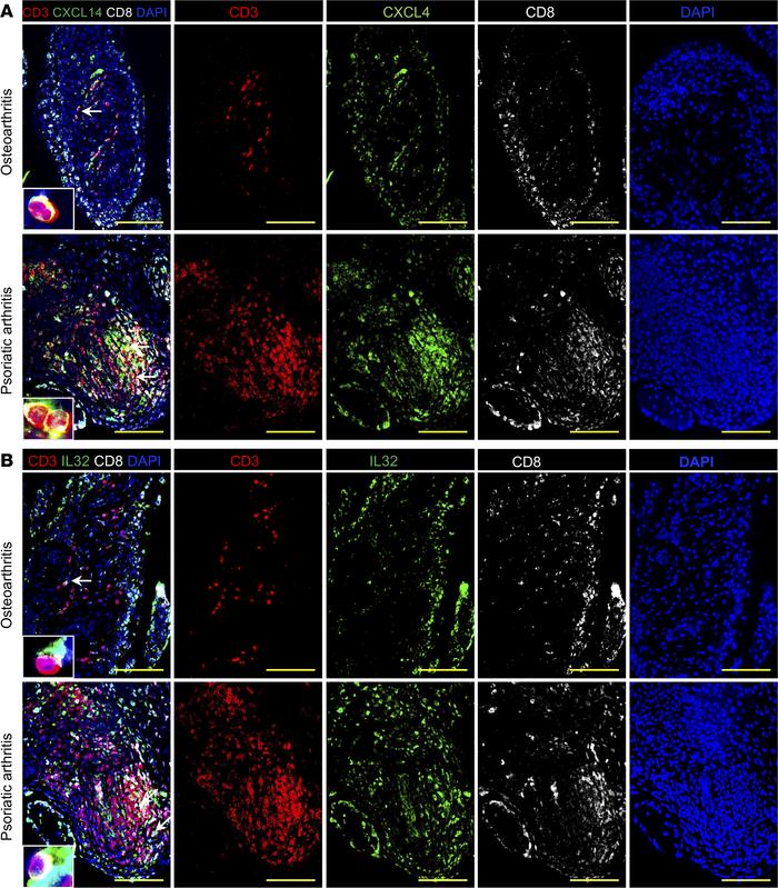 CXCL14- and IL-32–producing cells are abundant in the synovia of a patie...