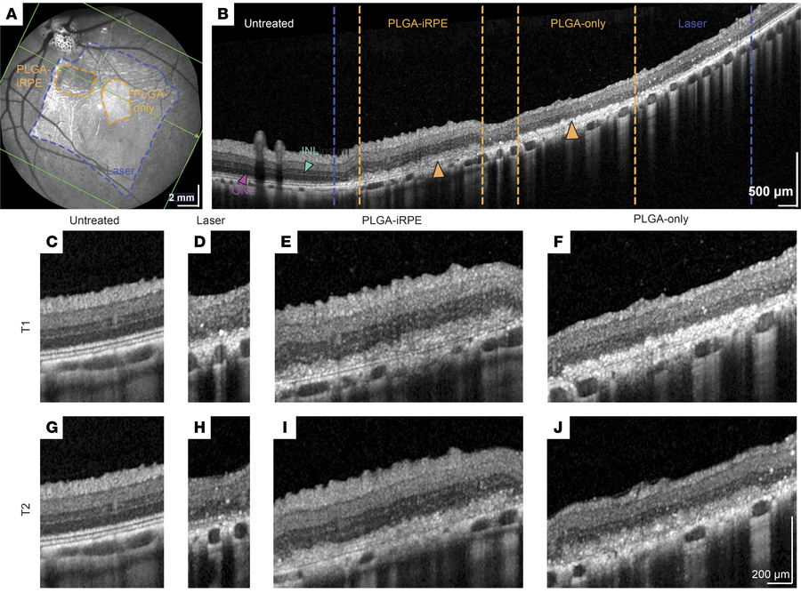 OCT evaluation of PLGA-iRPE and PLGA-only transplants in laser-injured p...
