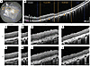 OCT evaluation of PLGA-iRPE and PLGA-only transplants in laser-injured porc