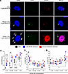 Radiation plus AZD6738 amplifies micronuclei (MN) numbers in NCI-H1299 cell
