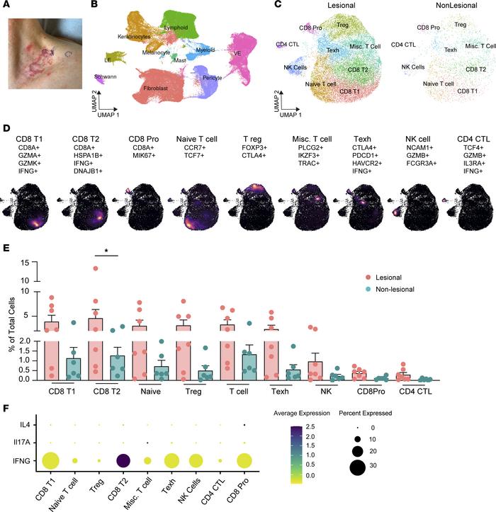 Immune cell landscape in lichen planus.
(A) Clinical photograph of lesio...