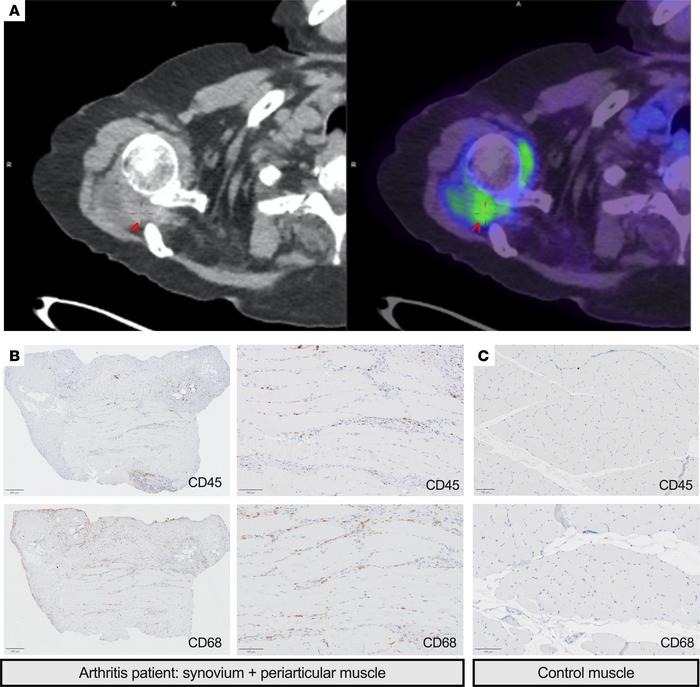 Periarticular myositis in patients with inflammatory arthritis.
(A) PET/...