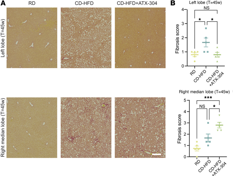 Heterogeneous amelioration of fibrosis in livers treated with ATX-304.
(...