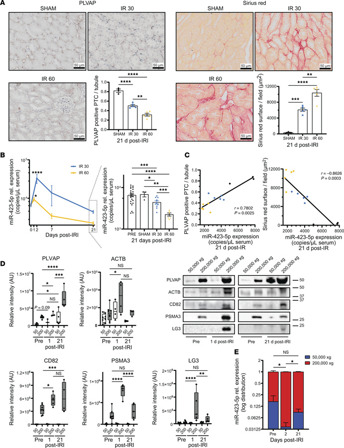 At a distance from IRI, lower miR-423-5p serum levels correlate with mor...