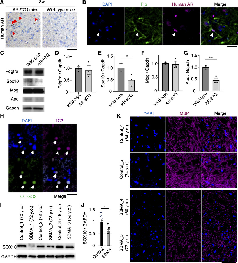 Oligodendrocytes are impaired in AR-97Q mice and patients with SBMA.
(A)...