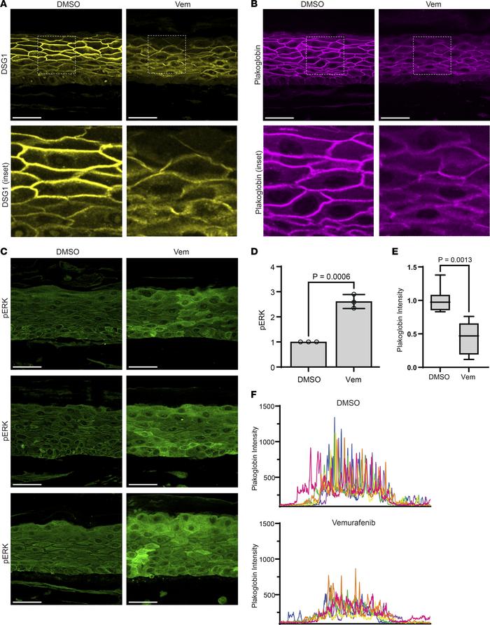 B-RAF inhibition is sufficient to disrupt cell-cell junctions and hypera...