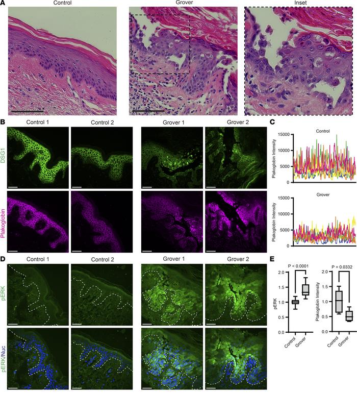 Idiopathic GD biopsies exhibit ERK hyperactivation along with desmosomal...