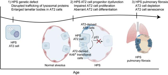 Time course of AT2 cell dysfunction in HPS-PF.
Our current working hypot...