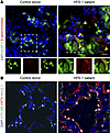 Senescence and a Krt8+ reprogrammed transitional cell state in a patient wi