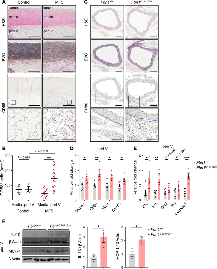 The periaortic inflammatory response of MFS mice and patients.
(A) Histo...