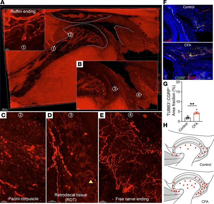 Anatomical distribution of TMJ innervation and increased sensory innerva...