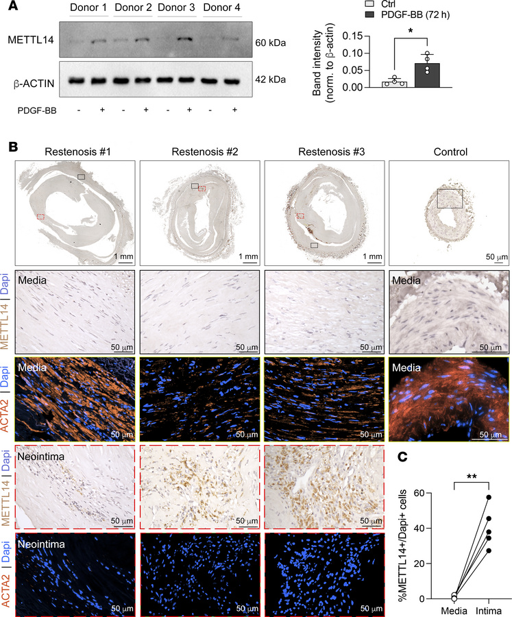 Increased METTL14 expression in the neointima of human restenotic sample...