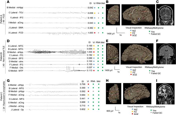 Neurophysiology, neuroimaging, and neuropathological features of study p...