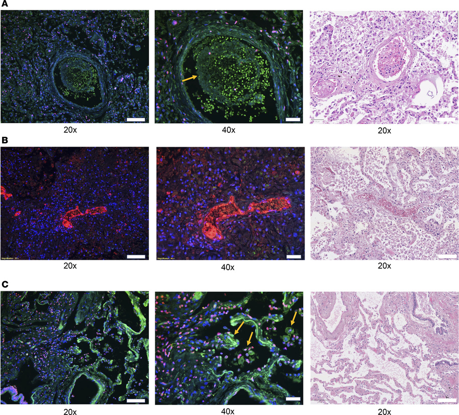 CD13 is highly expressed in lungs from patients with COVID-19.
Immunoflu...