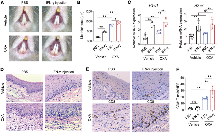 Local IFN-γ priming exacerbates OLP-like lesions by upregulating MHC I e...