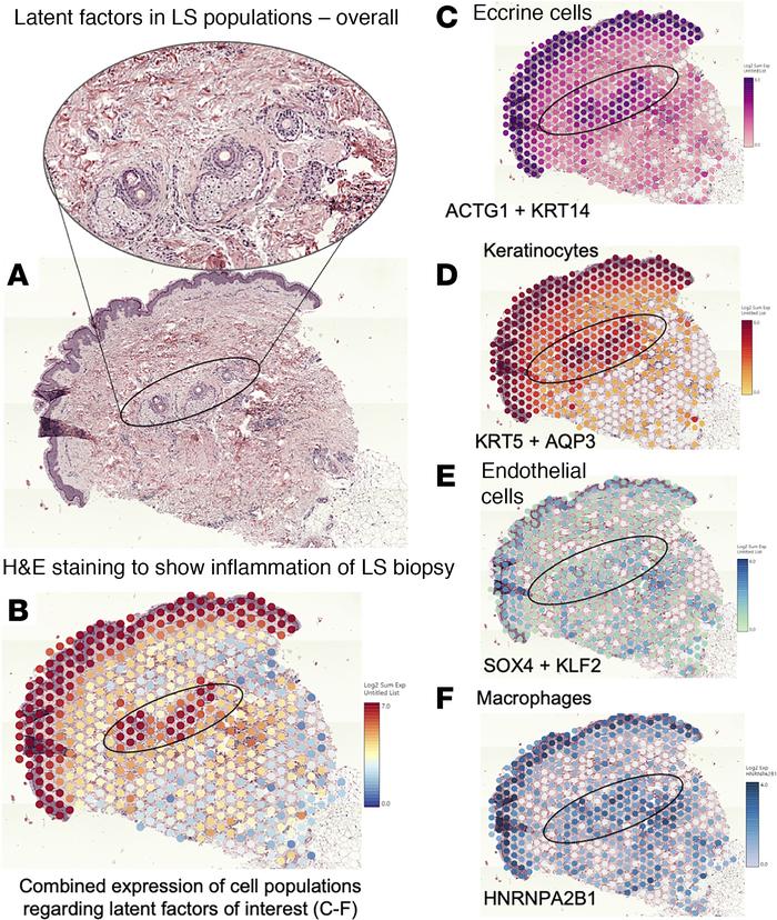 Spatial transcriptomics images of a representative LS from the dataset.
...