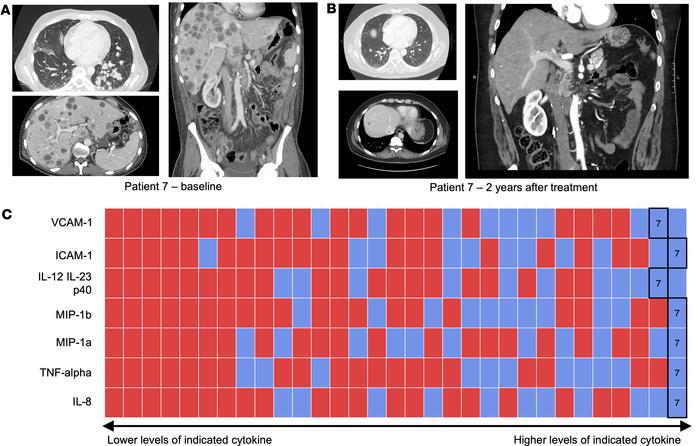 Relative cytokine levels in patient with exceptional response to ICI.
(A...