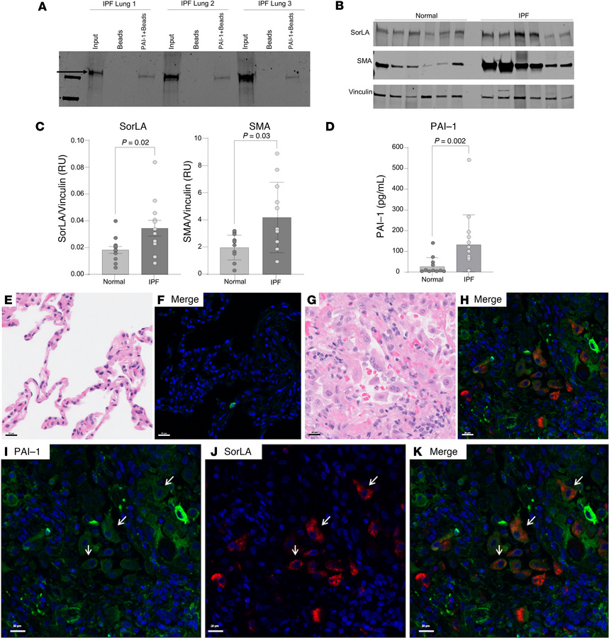 PAI-1WT binds to SorLA in lung tissue homogenates from patients with IPF...