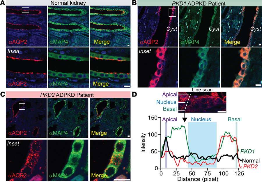 AQP2 is predominantly found in the cytoplasm of CD cells in kidney slice...