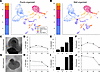Partial dissociation of a patient line presorted by organoid organization.