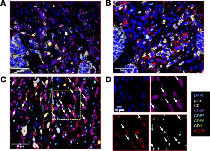 Immunofluorescence histochemical staining of patient lung tumor biopsy.
...