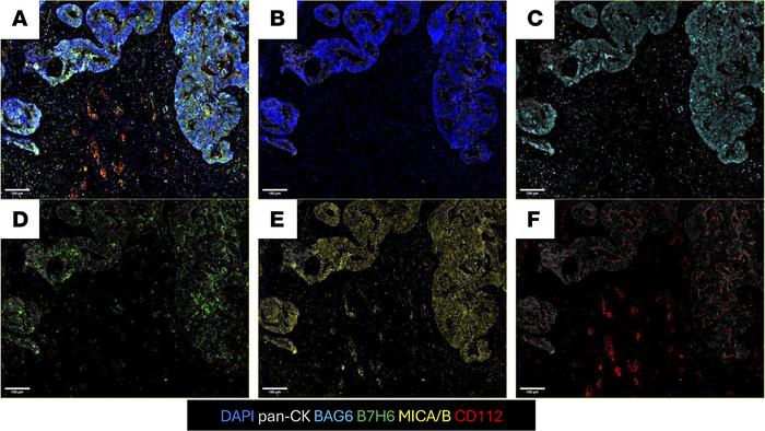 NK cell–activating receptor ligands expressed on tissue from patients wi...