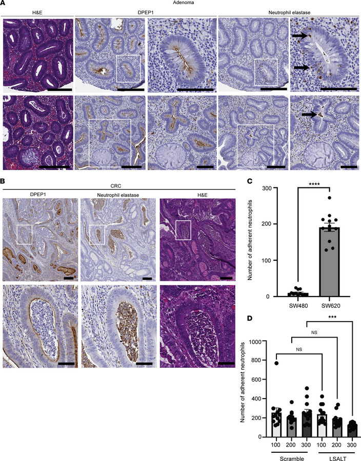 DPEP1 is linked to neutrophil presence and binding in CRC.
(A) Hematoxyl...
