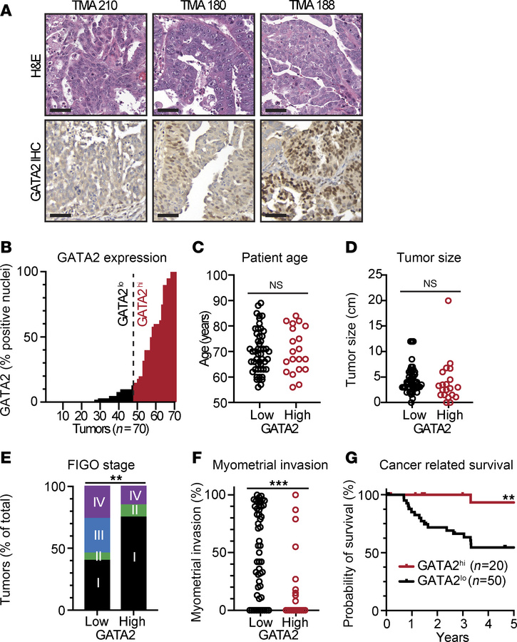GATA2 IHC correlates with low FIGO stage and with cancer-related and ove...