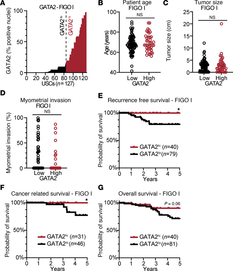 GATA2 IHC predicts recurrence and survival in FIGO stage I USC.
(A) Hist...