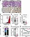 GATA2 IHC correlates with low FIGO stage and with cancer-related and overal