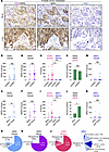 Stromal expression of ASPN occurs in the TME of HER2/HER3-expressing metast
