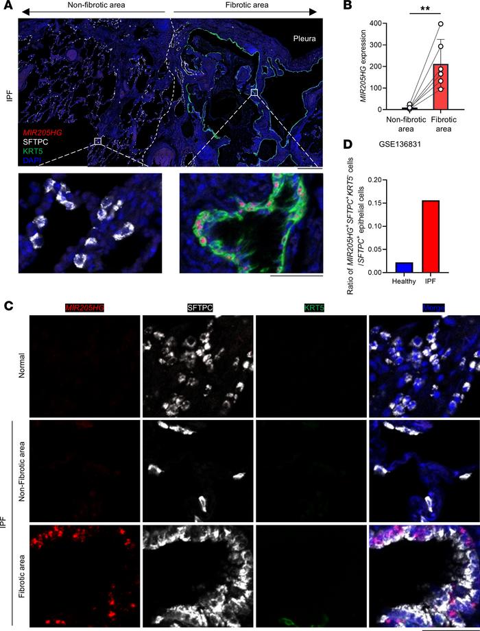 A subset of MIR205HG+ abnormal AT2 cells is increased in patients with I...