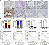 PSC activation score and CXCL13 expression around PanIN lesions in human PD