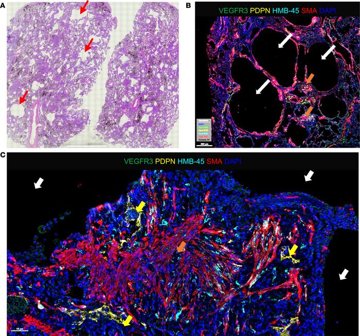 Identification of LAM nodules in patient LAM lung tissue.
(A) Tiled 20× ...