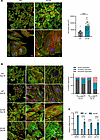 TTL p.G219S iPSC-CMs exhibit hypertrophic phenotypes.