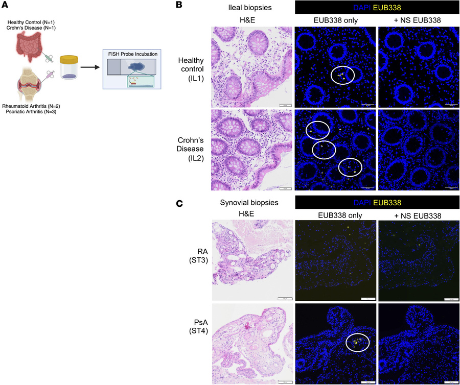 PsA but not RA synovial biopsies contain bacterial DNA.
Three PsA and 2 ...
