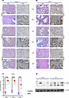 TIAM1 protein expression is elevated in BPH.